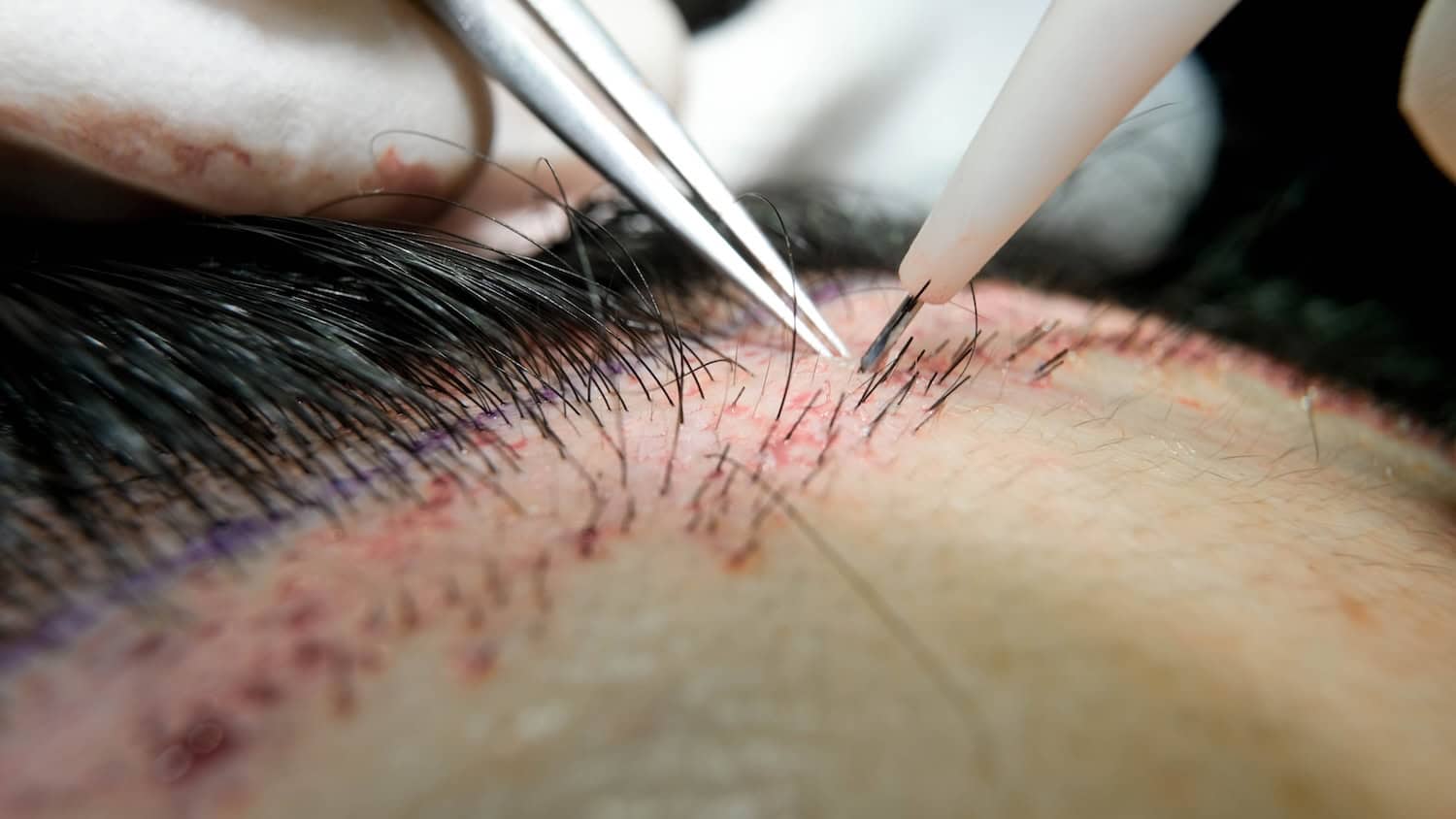 Hair transplant with DHI micrograft along hairline