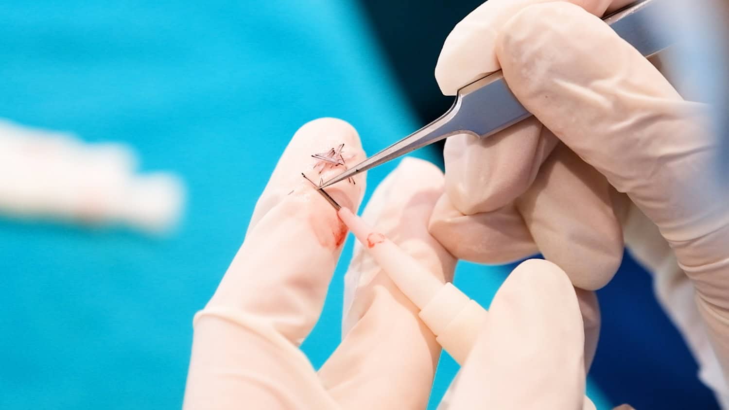 Hair graft extraction during DHI micrograft hair transplant