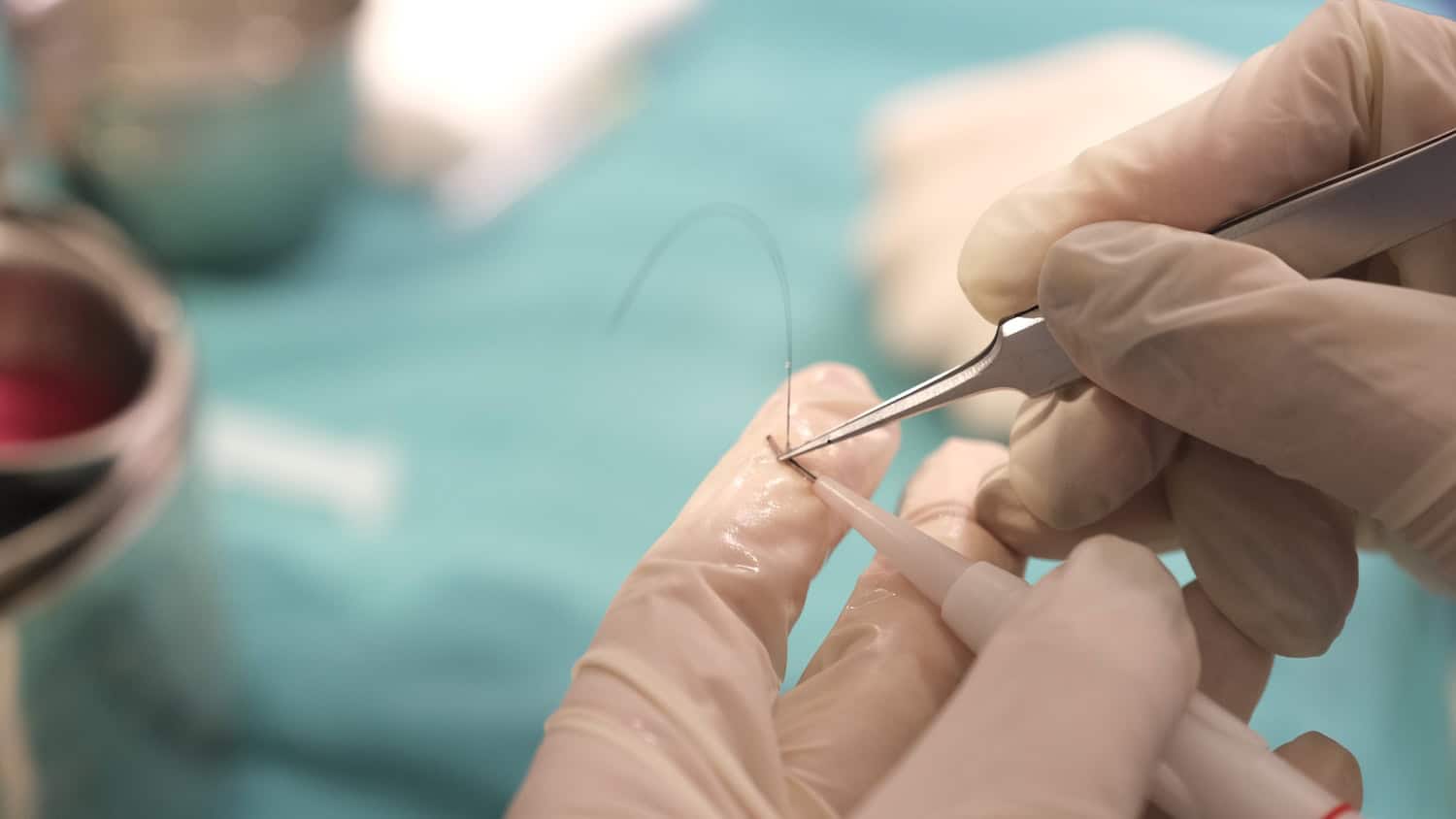 Precision thread work for a DHI hair transplant procedure