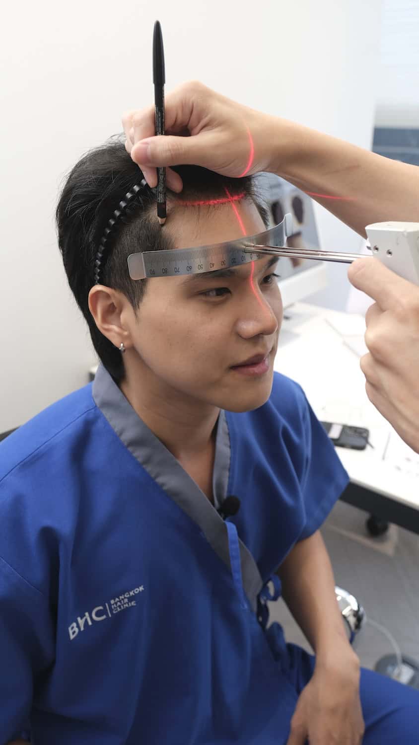 Hairline measurement before a DHI hair transplant