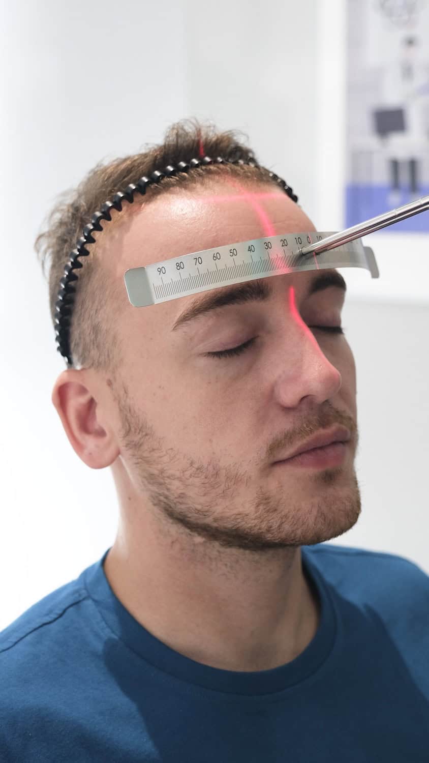 DHI hair transplant planning for an international patient