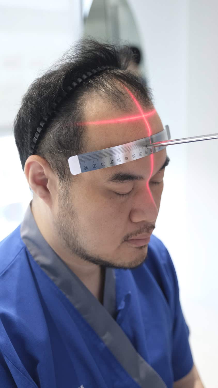Laser-guided hairline design for a DHI hair transplant