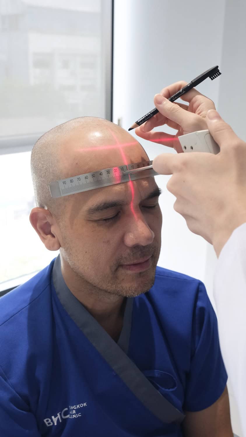 Laser hairline mapping before a DHI hair transplant