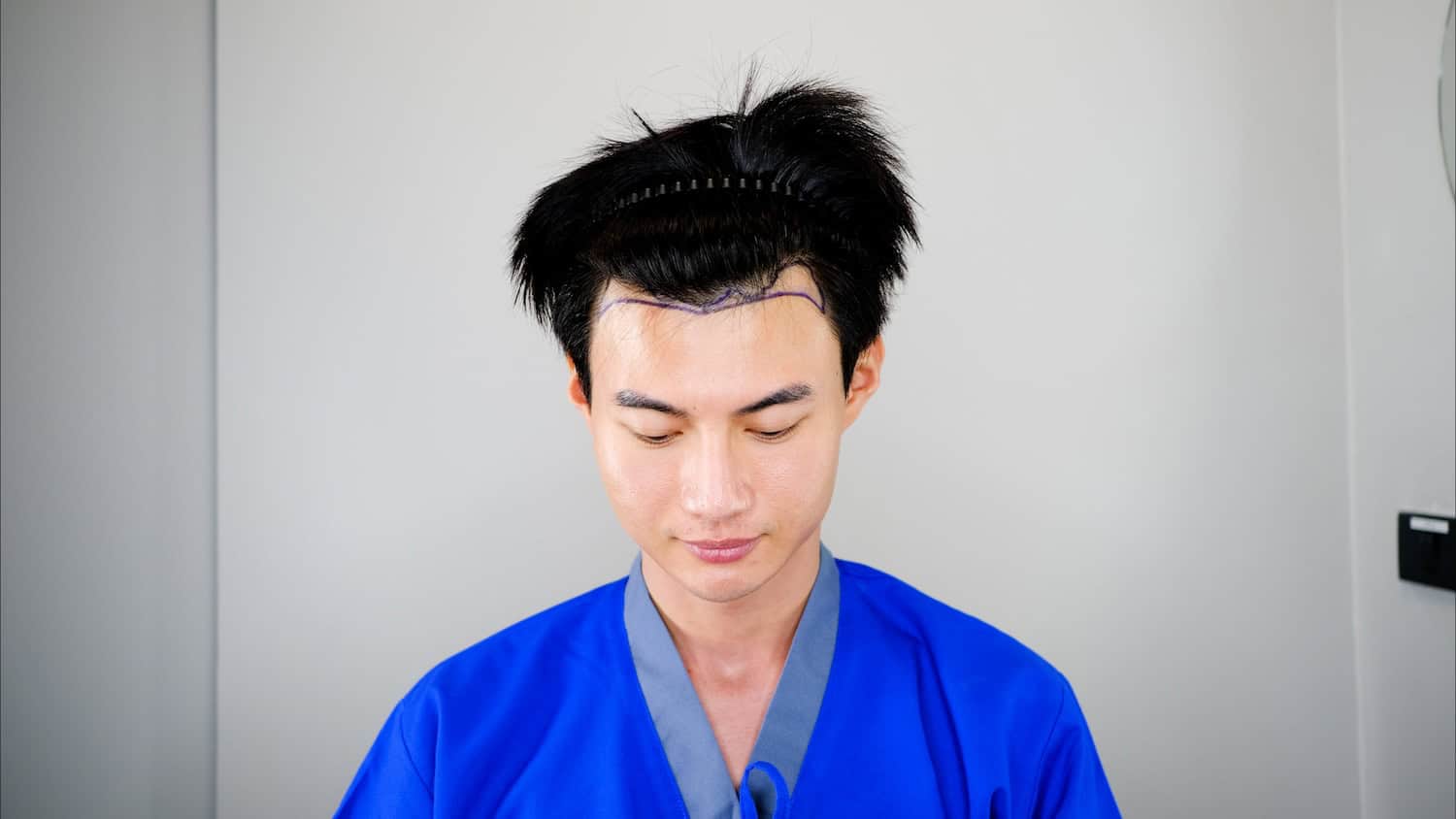 DHI micrograft preparation without shaving full head