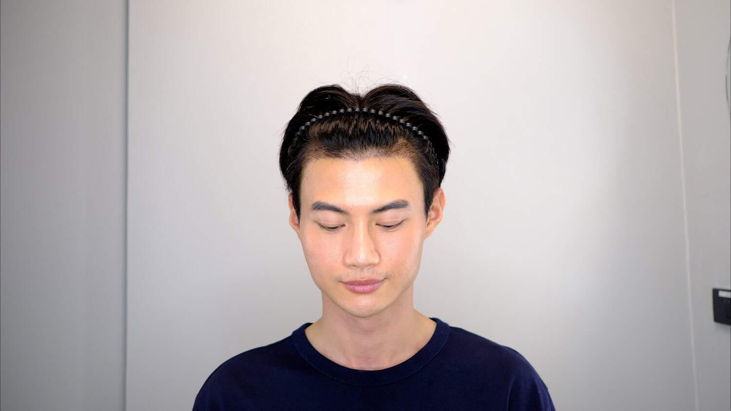 Natural hairline result after non-shaven DHI hair transplant