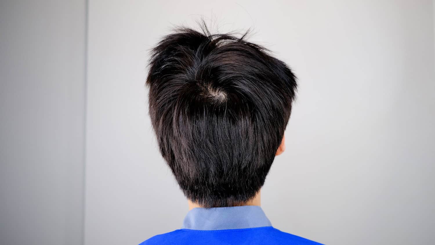 Non-shaven DHI hair transplant with concealed donor area 