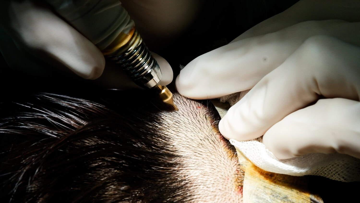 DHI non shaven hair transplant graft extraction process