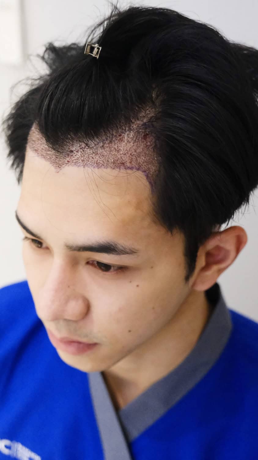 DHI non shaven hair transplant healing process view