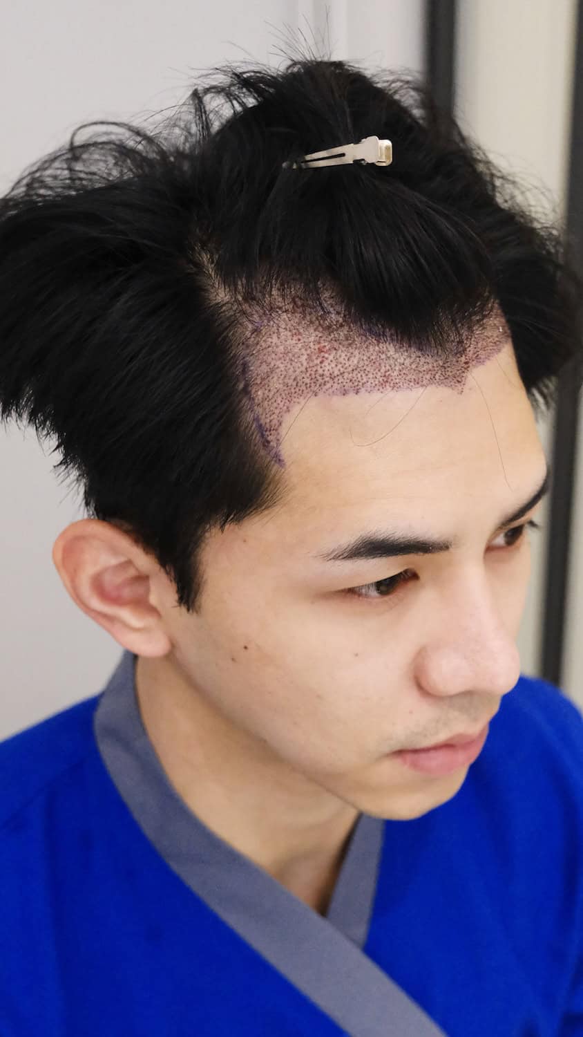 Non shaven DHI hair transplant with new frontal design
