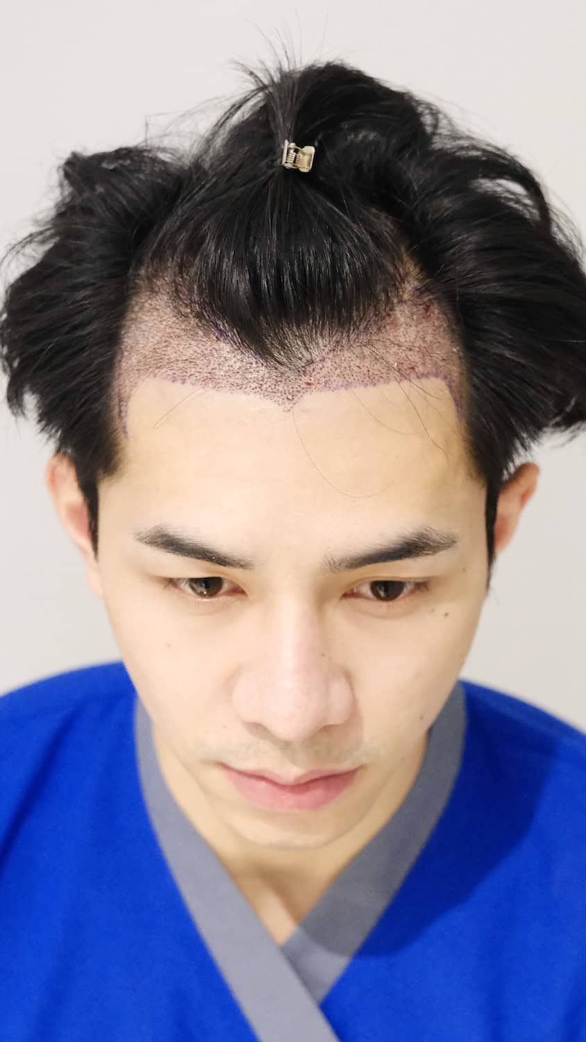 DHI micrograft frontal zone result without shaving