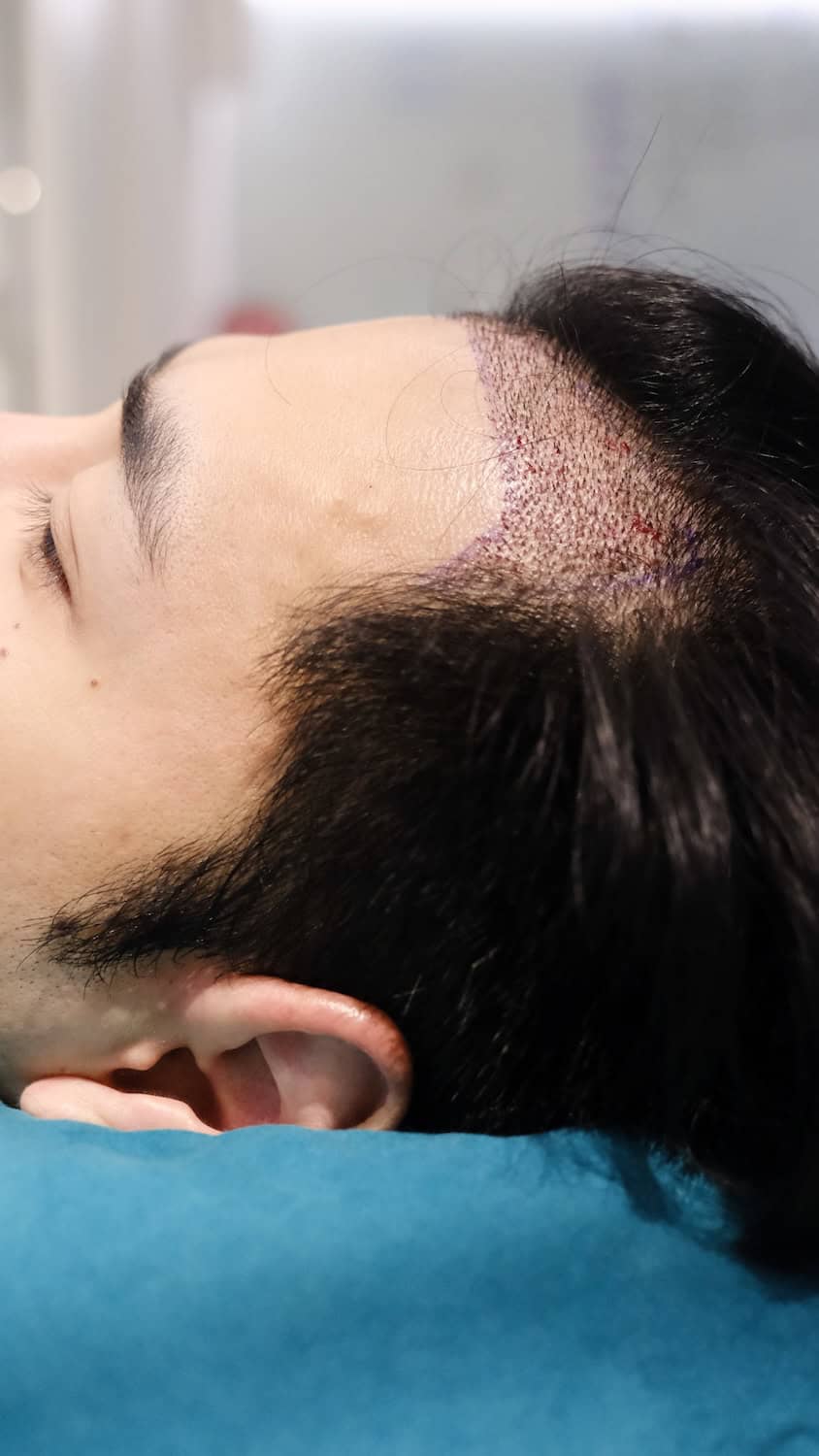 Temple area restored with non shaven DHI hair method