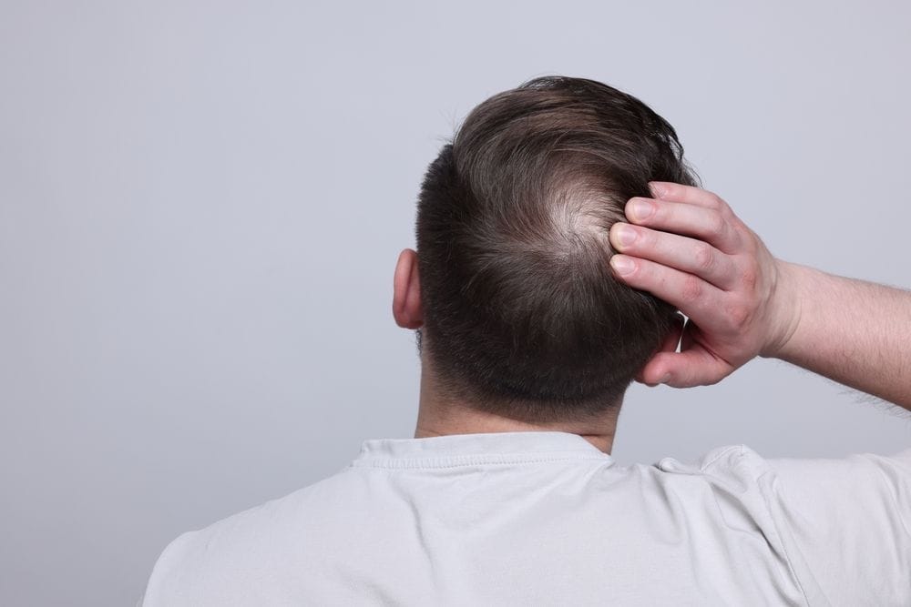 Man with hair thinning from DHT hormone hair loss
