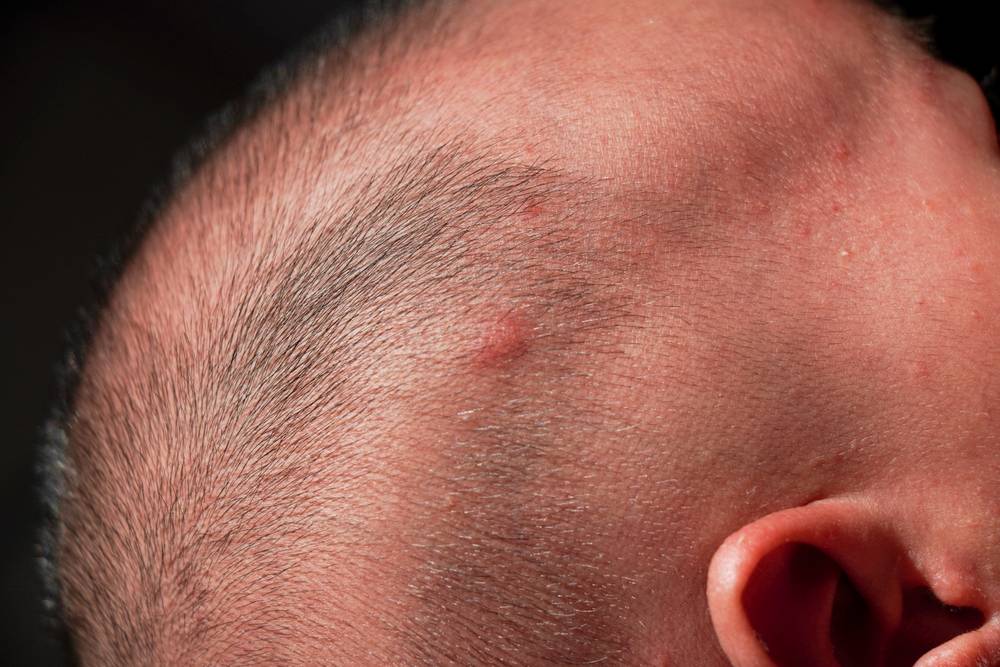 Pimples on Scalp: Causes, Symptoms, and Treatments