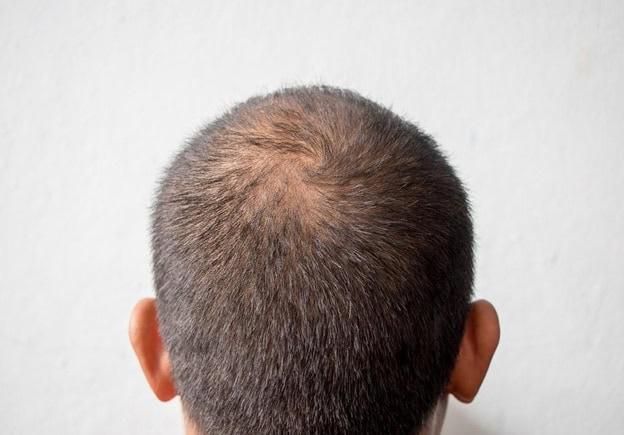 Male pattern baldness crown thinning before using finasteride for hair loss treatment.