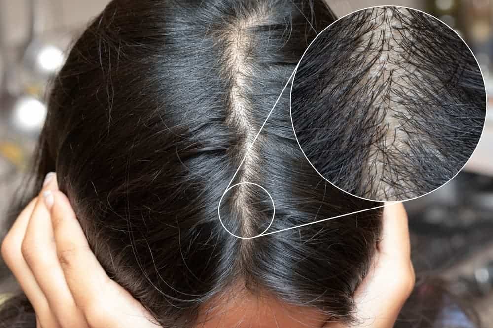 A woman with a widening part line who is looking to do scalp micropigmentation for women