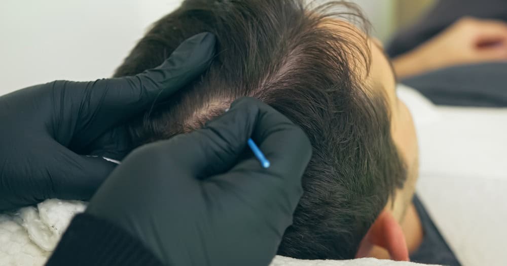 Scalp Micropigmentation vs. Hair Transplant Guide