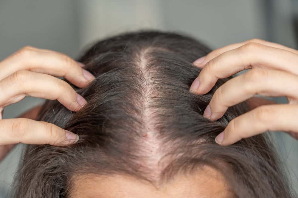 Woman noticing telogen effluvium hair loss with diffuse thinning across the scalp