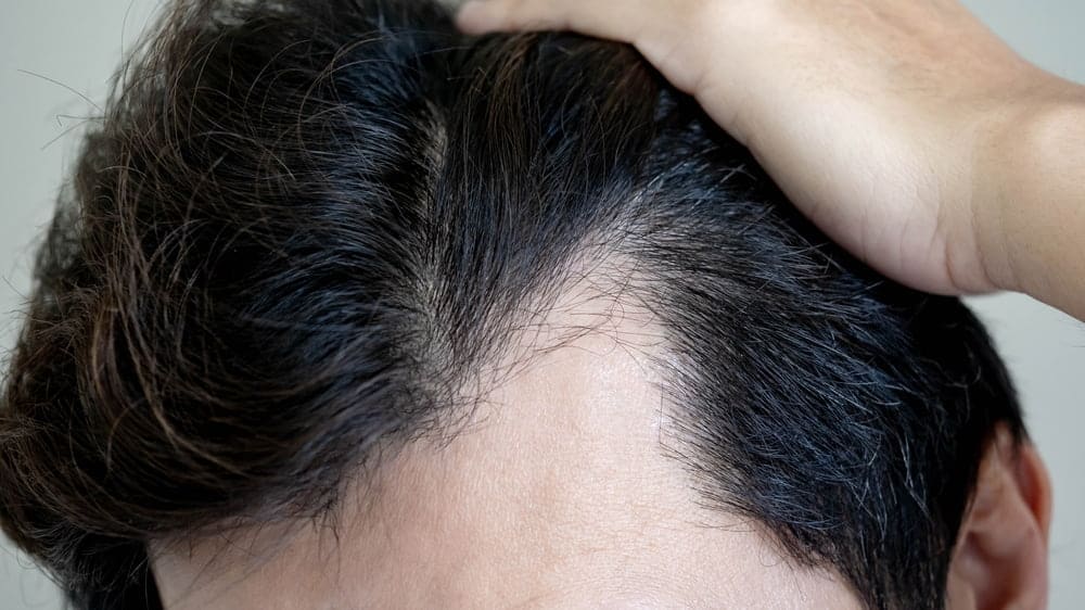 Temporal Point Hair Restoration: Techniques, Design, and Key Considerations
