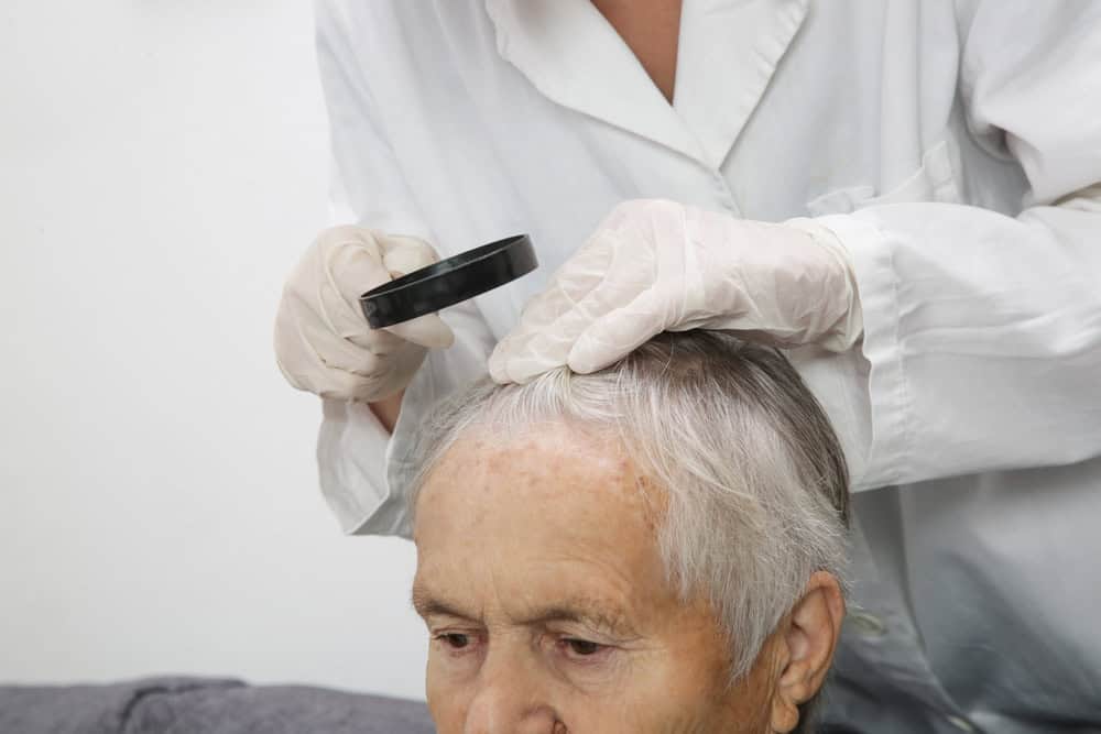 Scalp examination to assess alopecia areata in an elderly patient