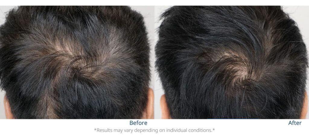 ผลลัพธ์ก่อนและหลังทำ LPT (Laser Peptide Therapy) บริเวณกลางศีรษะ